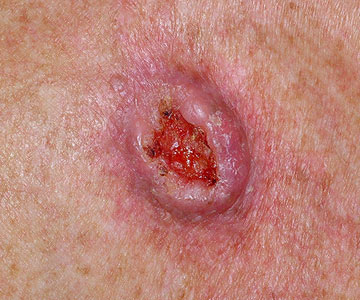 SCC-invasive.jpg
