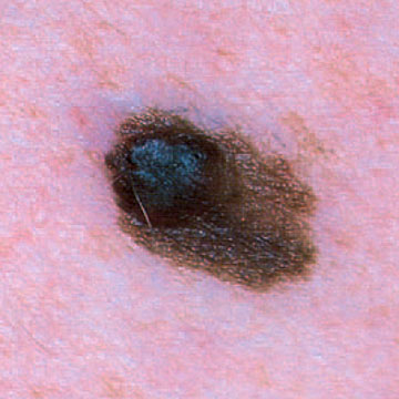 SCF-IntermediateMelanoma-007.jpg