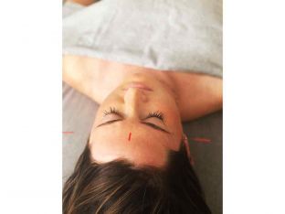 acupuncture
