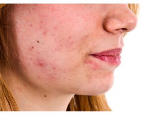 closeup of anonymous teen girl with acne
