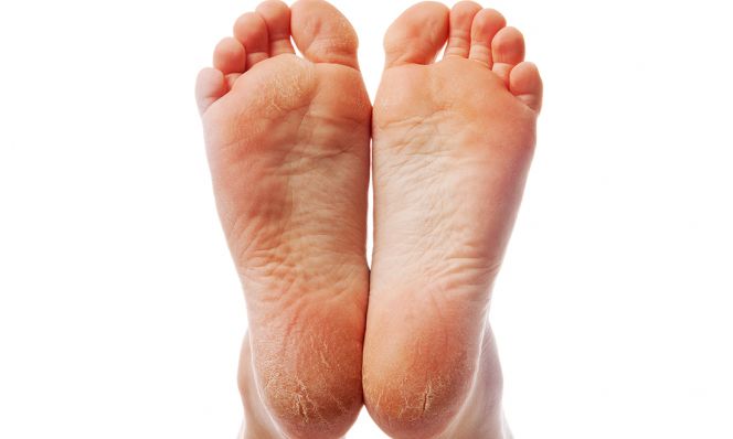dry cracked feet